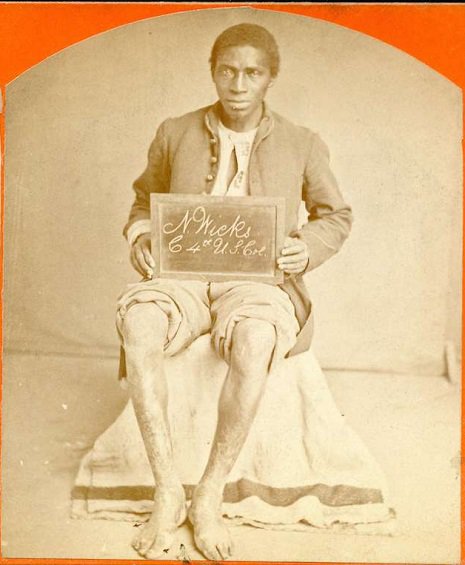 Portraits de vétérans blessés durant la guerre de Sécession portraits de veterans blesses amputes durant la guerre de secession 5 portraits-de-veterans-blesses-amputes-durant-la-guerre-de-secession-5