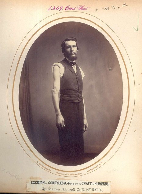 Portraits de vétérans blessés durant la guerre de Sécession portraits de veterans blesses amputes durant la guerre de secession 6 portraits-de-veterans-blesses-amputes-durant-la-guerre-de-secession-6