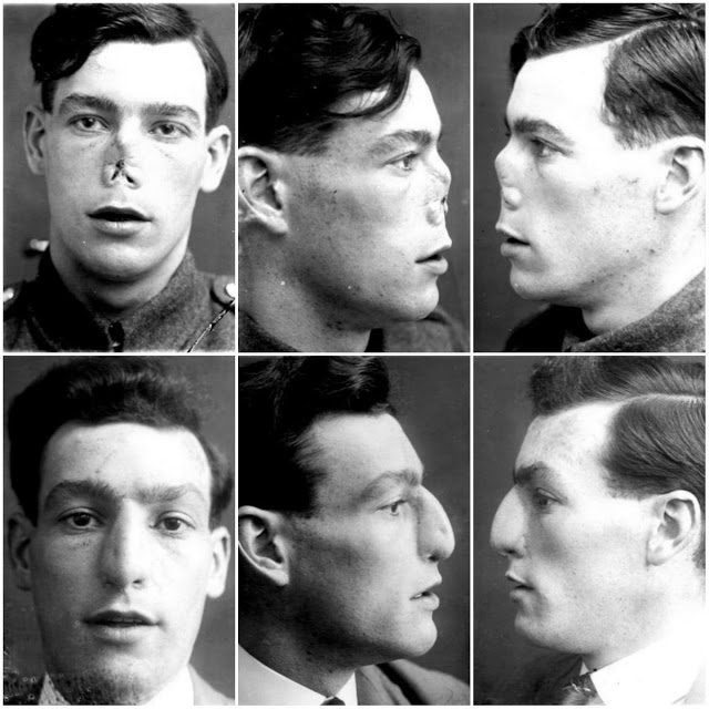 Faces from the Front : les visages réparés de soldats de la première guerre mondiale Faces from the Front les visages repares de soldats de la premiere guerre mondiale 6 Joseph Pickard avant après chirurgie reconstructrice 1919 1921
