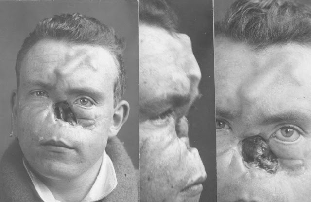 Faces from the Front : les visages réparés de soldats de la première guerre mondiale Faces from the Front les visages repares de soldats de la premiere guerre mondiale 7 le lieutenant William Spreckley avant le traitement avec son nez manquant