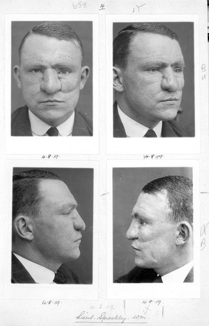 Faces from the Front : les visages réparés de soldats de la première guerre mondiale Faces from the Front les visages repares de soldats de la premiere guerre mondiale 8 Spreckley après son opération