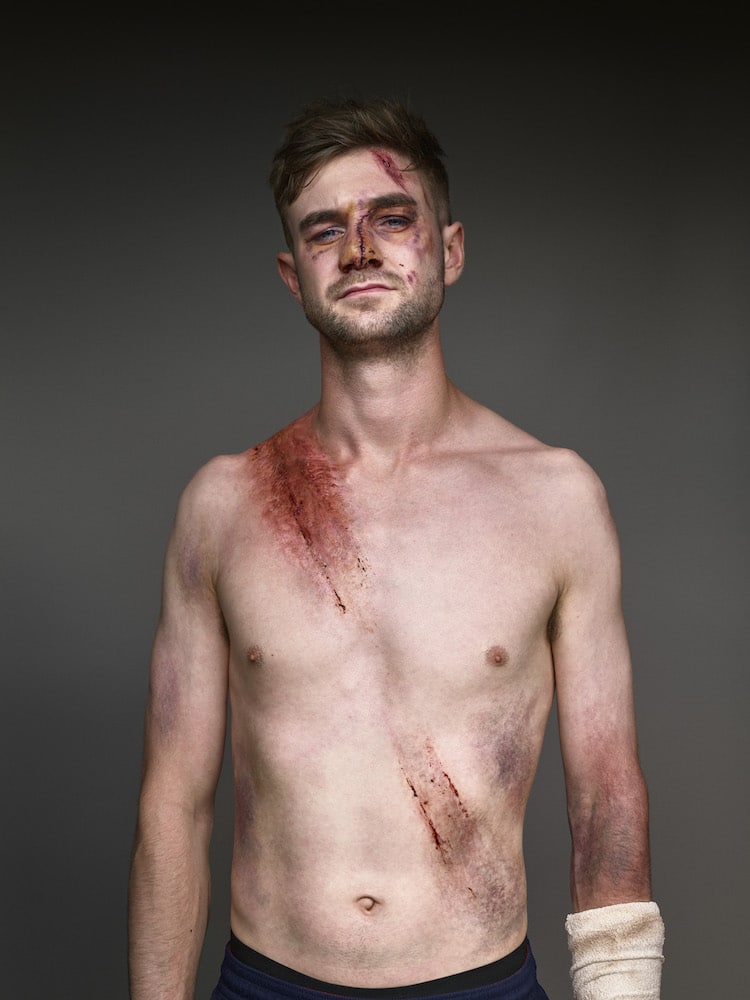 Des portraits de survivants d'accidents grace à la ceinture de sécurité Des portraits de survivants d accidents grace a la ceinture de securite 7 Des-portraits-de-survivants-d-accidents-grace-a-la-ceinture-de-securite-7