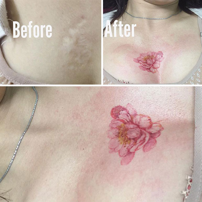 30 recouvrements de cicatrices par des tatouages par Tran Bich Ngoc 30 recouvrements de cicatrices par des tatouages par Tran Bich Ngoc 25 30-recouvrements-de-cicatrices-par-des-tatouages-par-Tran-Bich-Ngoc-25