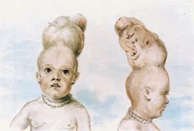 Le garçon à deux têtes du Bengale Le garcon a deux tetes du Bengale inde 2 Le-garcon-a-deux-tetes-du-Bengale-inde-2