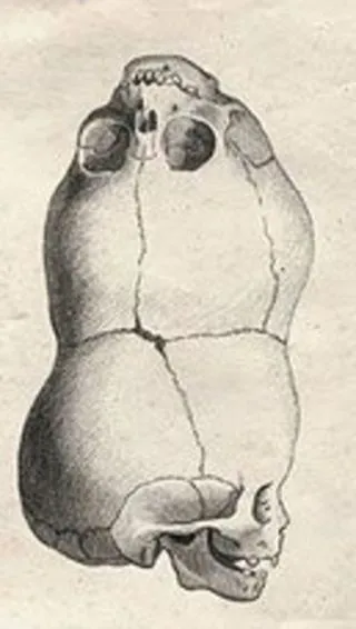 Le garçon à deux têtes du Bengale Le garcon a deux tetes du Bengale inde 3 crane Le-garcon-a-deux-tetes-du-Bengale-inde-3-crane