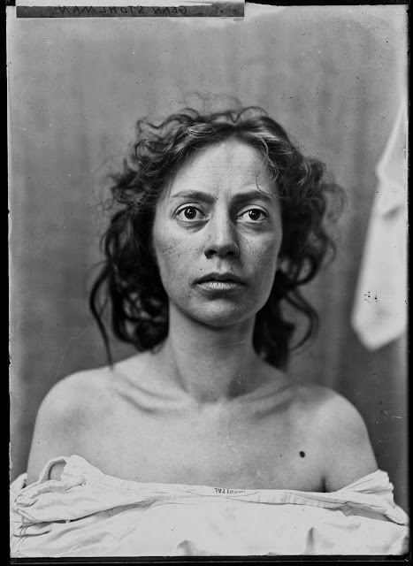 Quelques portraits des patients du Dr Harvey Cushing au début du XXème siècle quelques portraits des patients du dr harvey cushing au debut du xxeme siecle 1 quelques-portraits-des-patients-du-dr-harvey-cushing-au-debut-du-xxeme-siecle-1