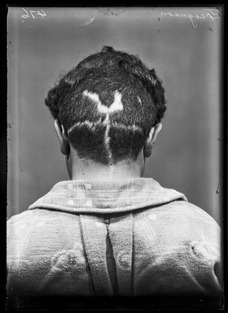 Quelques portraits des patients du Dr Harvey Cushing au début du XXème siècle quelques portraits des patients du dr harvey cushing au debut du xxeme siecle 12 quelques-portraits-des-patients-du-dr-harvey-cushing-au-debut-du-xxeme-siecle-12