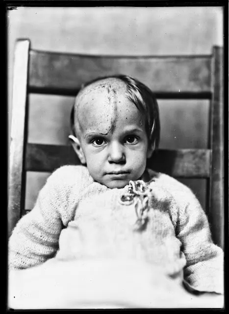 Quelques portraits des patients du Dr Harvey Cushing au début du XXème siècle quelques portraits des patients du dr harvey cushing au debut du xxeme siecle 15 quelques-portraits-des-patients-du-dr-harvey-cushing-au-debut-du-xxeme-siecle-15