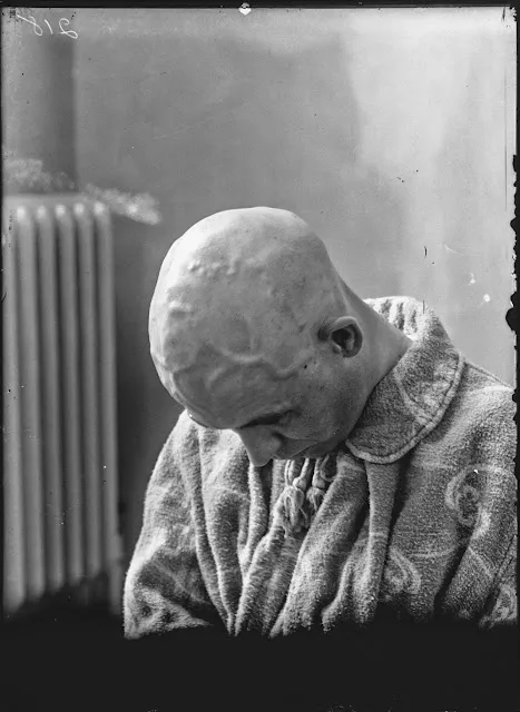 Quelques portraits des patients du Dr Harvey Cushing au début du XXème siècle quelques portraits des patients du dr harvey cushing au debut du xxeme siecle 19 quelques-portraits-des-patients-du-dr-harvey-cushing-au-debut-du-xxeme-siecle-19