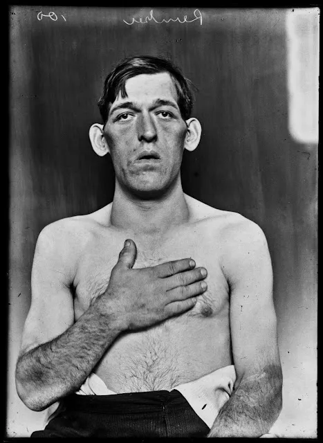 Quelques portraits des patients du Dr Harvey Cushing au début du XXème siècle quelques portraits des patients du dr harvey cushing au debut du xxeme siecle 22 quelques-portraits-des-patients-du-dr-harvey-cushing-au-debut-du-xxeme-siecle-22