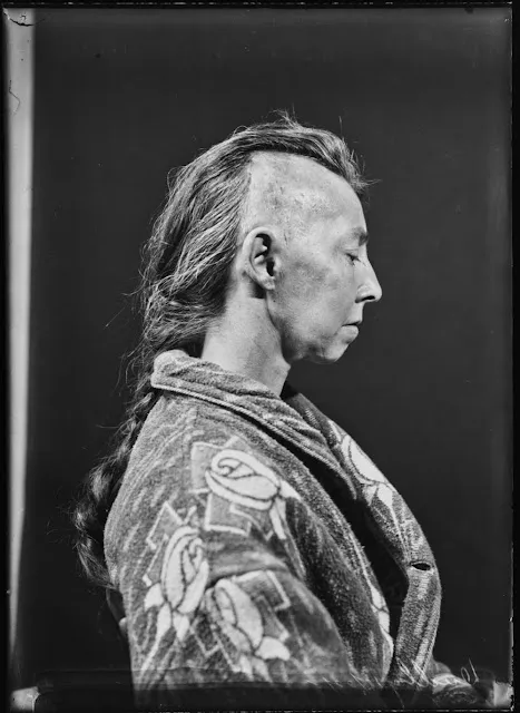 Quelques portraits des patients du Dr Harvey Cushing au début du XXème siècle quelques portraits des patients du dr harvey cushing au debut du xxeme siecle 3 quelques-portraits-des-patients-du-dr-harvey-cushing-au-debut-du-xxeme-siecle-3