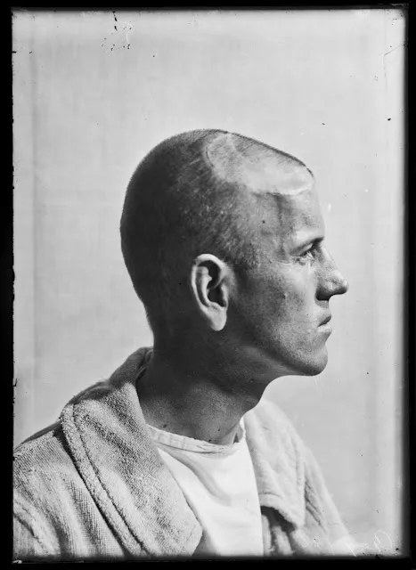 Quelques portraits des patients du Dr Harvey Cushing au début du XXème siècle quelques portraits des patients du dr harvey cushing au debut du xxeme siecle 4 quelques-portraits-des-patients-du-dr-harvey-cushing-au-debut-du-xxeme-siecle-4