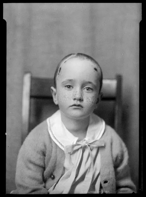 Quelques portraits des patients du Dr Harvey Cushing au début du XXème siècle quelques portraits des patients du dr harvey cushing au debut du xxeme siecle 6 quelques-portraits-des-patients-du-dr-harvey-cushing-au-debut-du-xxeme-siecle-6