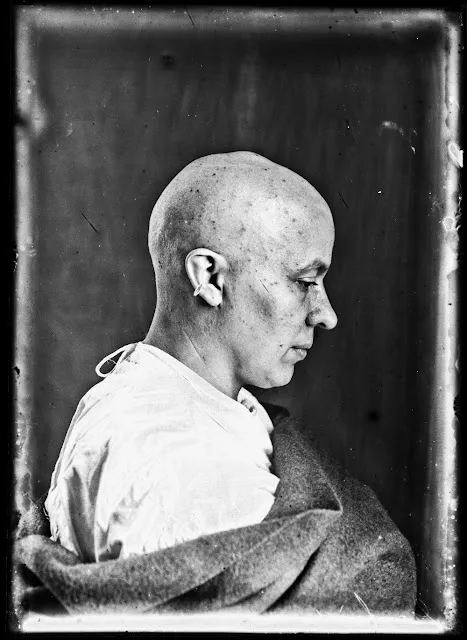 Quelques portraits des patients du Dr Harvey Cushing au début du XXème siècle quelques portraits des patients du dr harvey cushing au debut du xxeme siecle 8 quelques-portraits-des-patients-du-dr-harvey-cushing-au-debut-du-xxeme-siecle-8