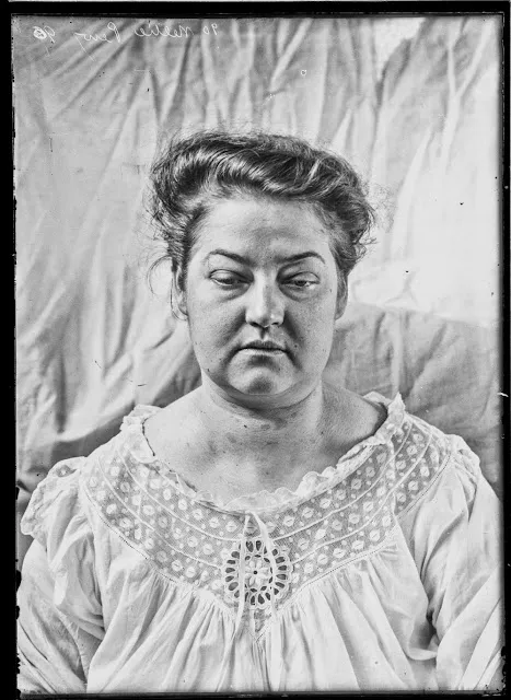 Quelques portraits des patients du Dr Harvey Cushing au début du XXème siècle quelques portraits des patients du dr harvey cushing au debut du xxeme siecle 9 quelques-portraits-des-patients-du-dr-harvey-cushing-au-debut-du-xxeme-siecle-9